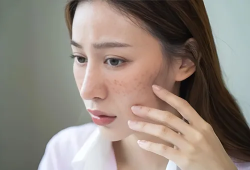 铅汞脸、激素脸如何恢复健康洁白肌肤，浅谈问题肌肤的修复之路！